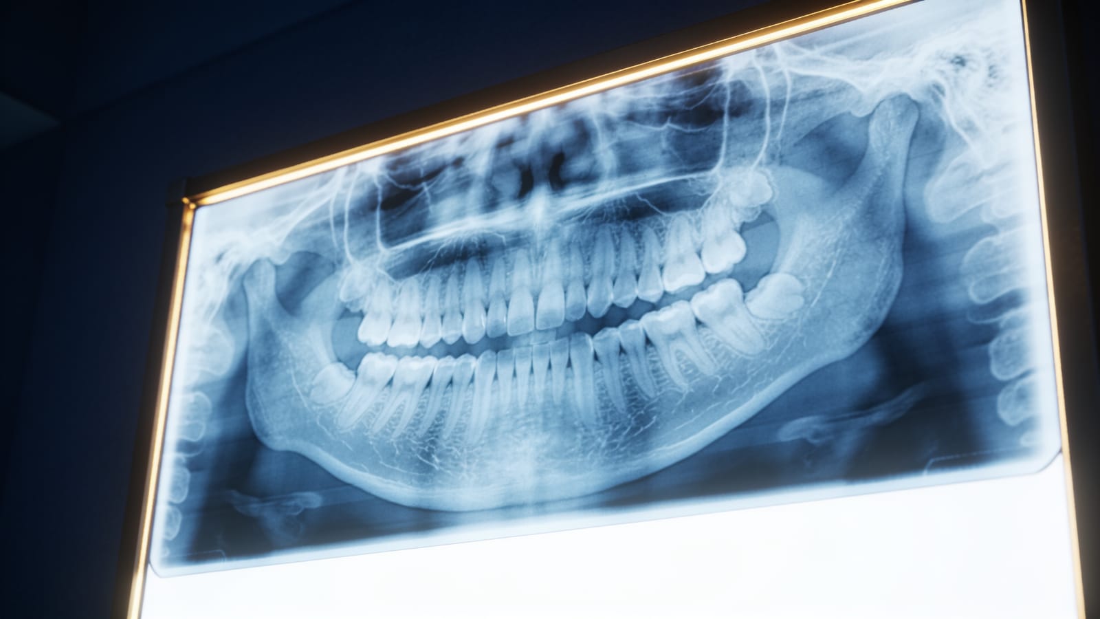 Radiografía panorámica dental iluminada sobre un negatoscopio